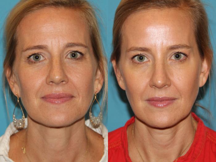 Before & After BOTOX® Cosmetic Case 107 View #1 View in Atlanta, Georgia