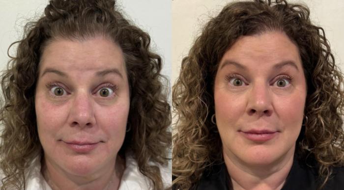Before and after full face Dysport and subtle filler for facial balancing by Ashlie Walsh, PA-C