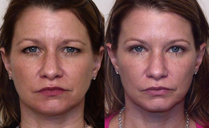 Before & After Eyelid Surgery (Blepharoplasty) Case 16 View #2 View in Atlanta, Georgia