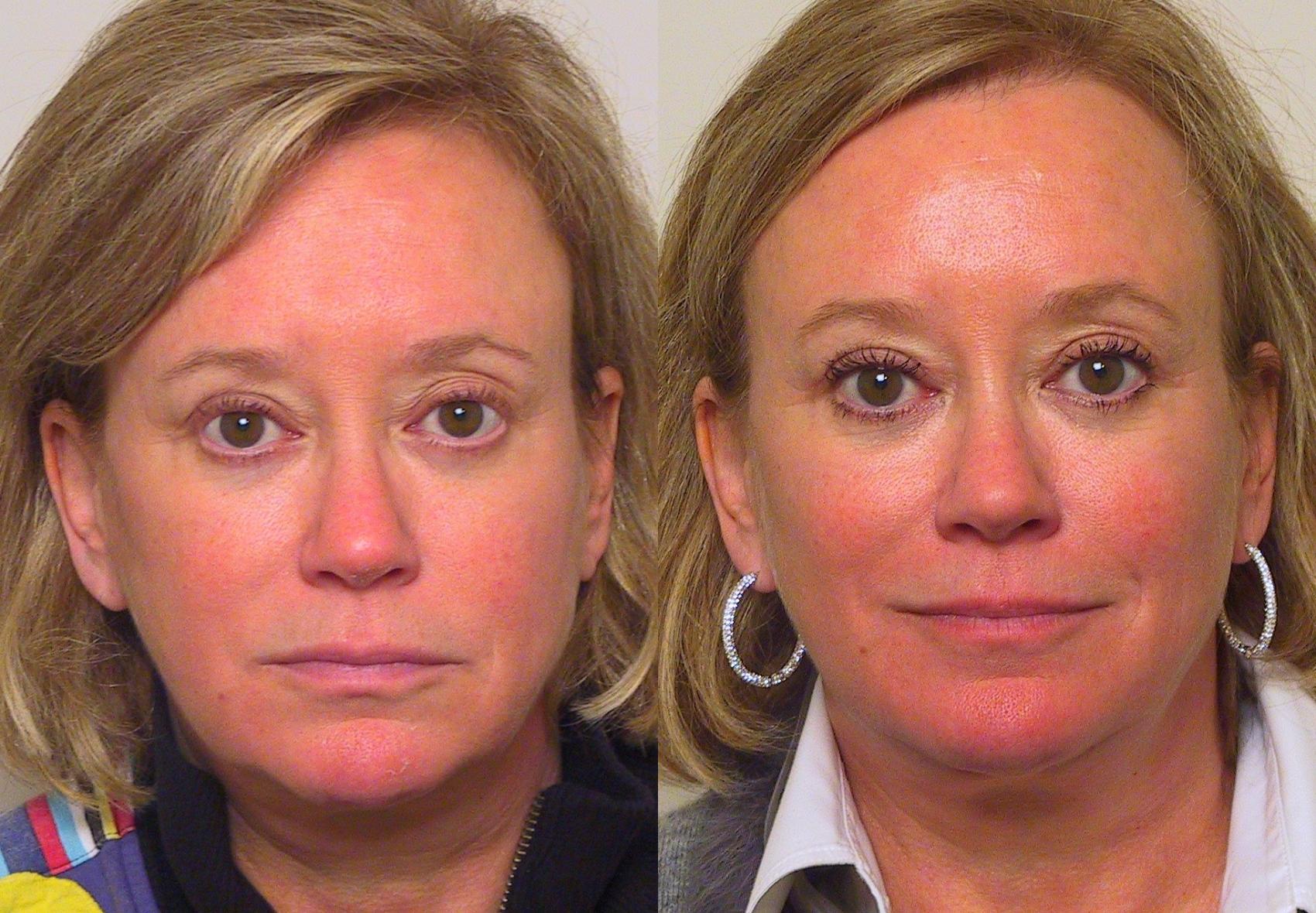 Before & After Eyelid Surgery (Blepharoplasty) Case 22 View #1 View in Atlanta, Georgia