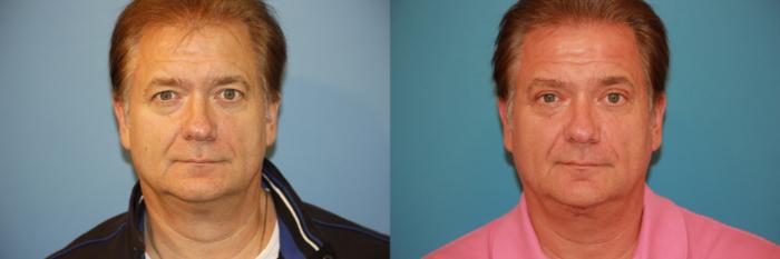 Before & After Eyelid Surgery (Blepharoplasty) Case 70 View #1 View in Atlanta, Georgia