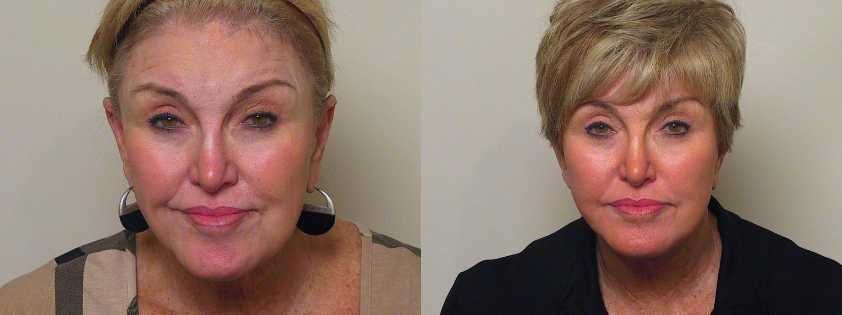 Facelift Before And After Pictures Case Atlanta Georgia