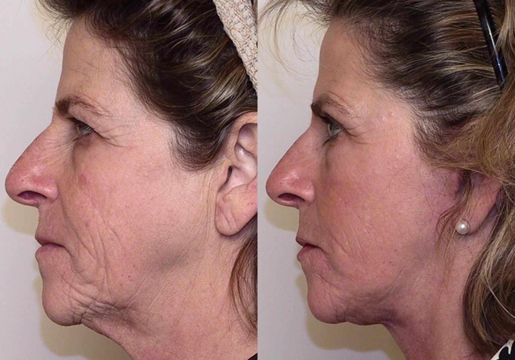 Facelift Before And After Pictures Case Atlanta Georgia Buckhead