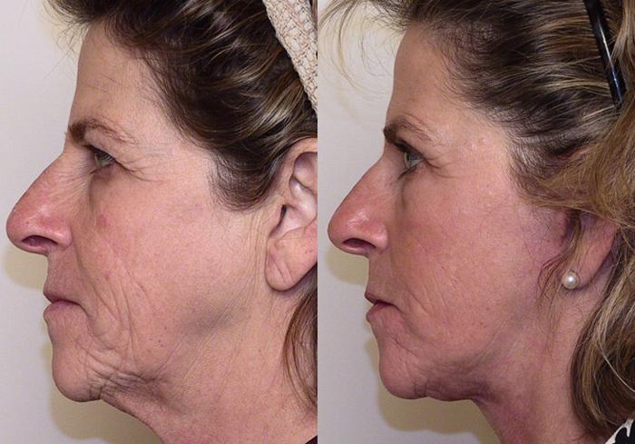 Before & After Facelift Case 7 View #3 View in Atlanta, Georgia