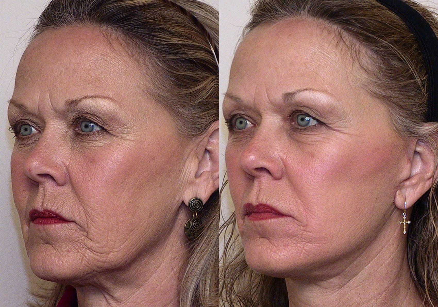Facelift Before And After Pictures Case Atlanta Georgia Buckhead