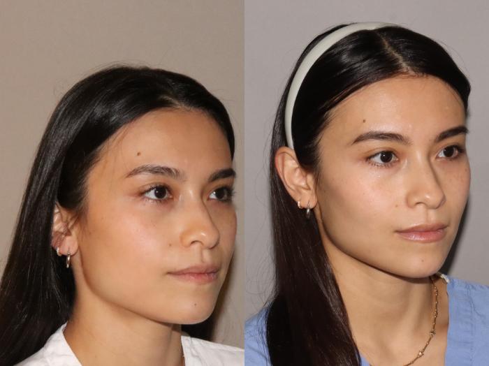 Before & After Facial Rejuvenation Case 166 Right Oblique View in Atlanta, Georgia