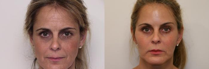 Before & After BOTOX® Cosmetic Case 17 View #1 View in Atlanta, Georgia
