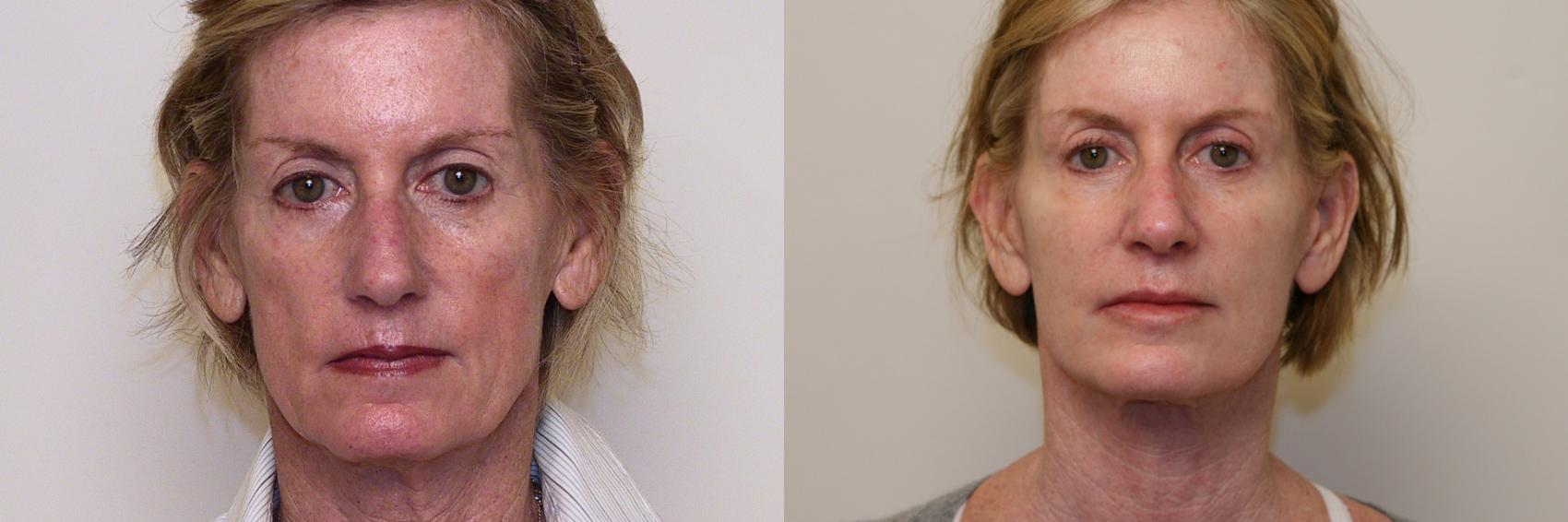 Before & After Facial Rejuvenation Case 46 View #1 View in Atlanta, Georgia