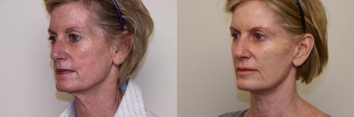 Before & After Facial Rejuvenation Case 46 View #2 View in Atlanta, Georgia