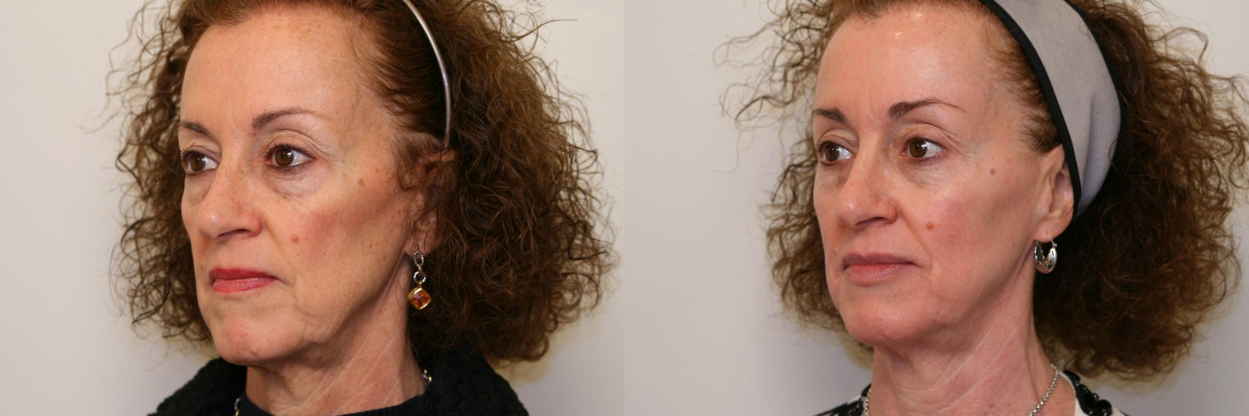 Before & After Dermal Fillers Case 48 View #1 View in Atlanta, Georgia
