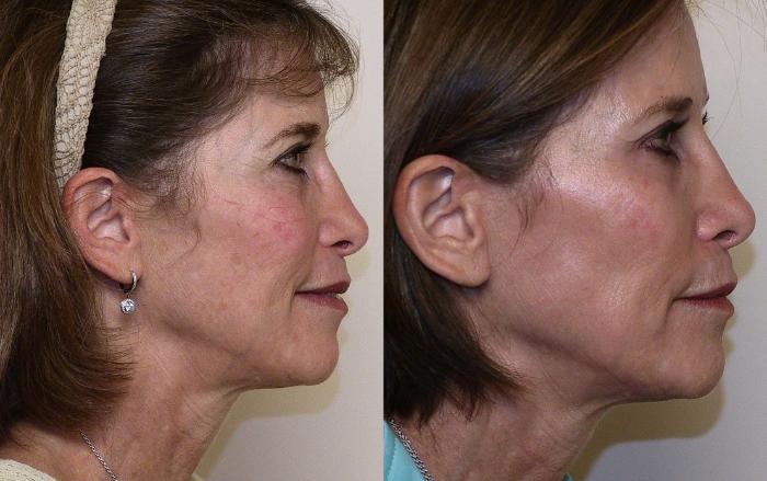 Before & After Laser Treatments Case 19 View #1 View in Atlanta, Georgia
