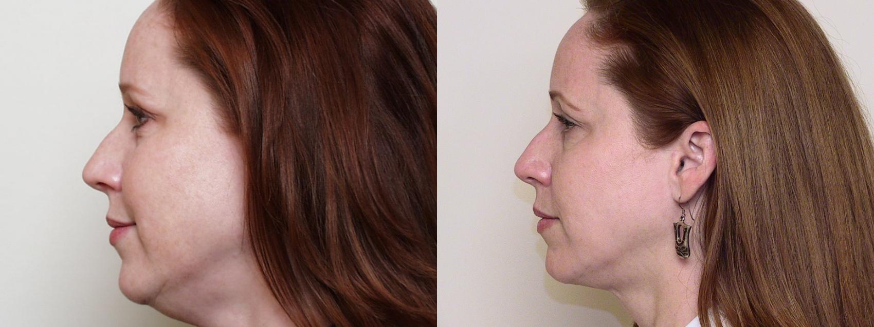 Before & After Neck Lift (Submentoplasty) Case 44 View #1 View in Atlanta, Georgia