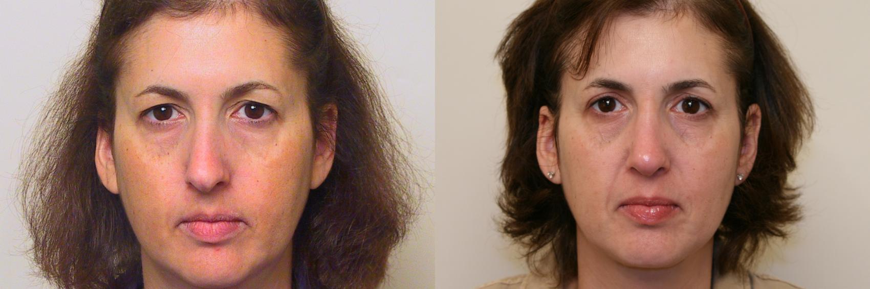 Neck Lift Submentoplasty Before And After Pictures Case Atlanta