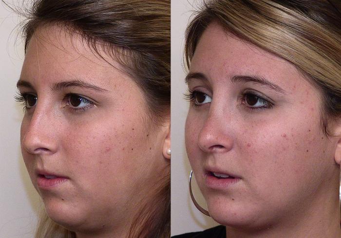 Before & After Rhinoplasty Case 1 View #2 View in Atlanta, Georgia