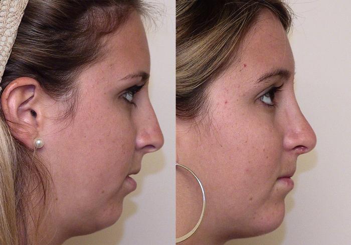 Before & After Rhinoplasty Case 1 View #3 View in Atlanta, Georgia