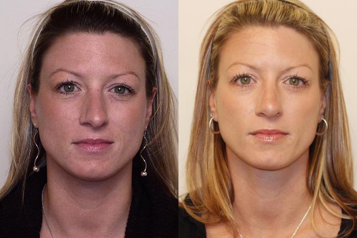Before & After Rhinoplasty Case 29 View #2 View in Atlanta, Georgia