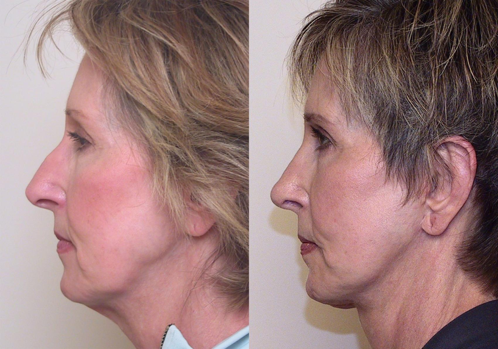 Before & After Rhinoplasty Case 3 View #1 View in Atlanta, Georgia