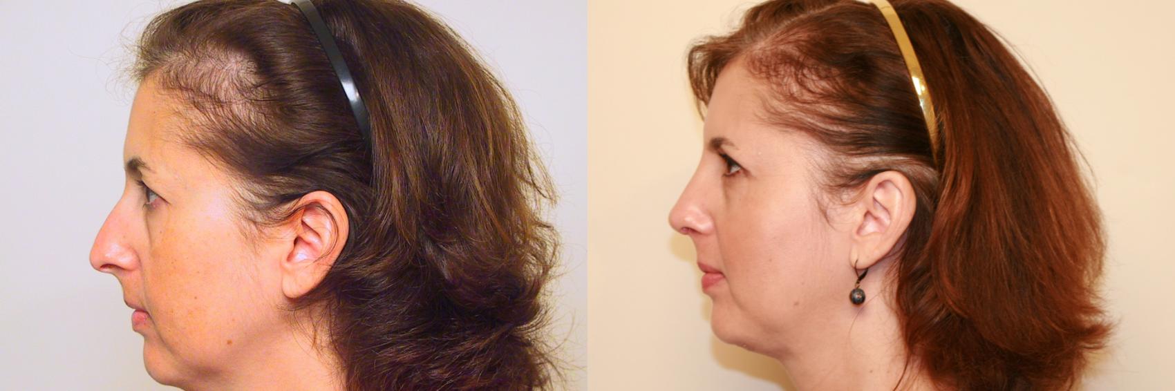 Before & After Rhinoplasty Case 38 View #1 View in Atlanta, Georgia