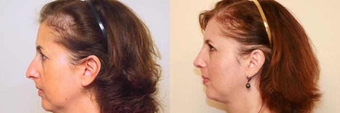 Before & After Rhinoplasty Case 38 View #1 View in Atlanta, Georgia