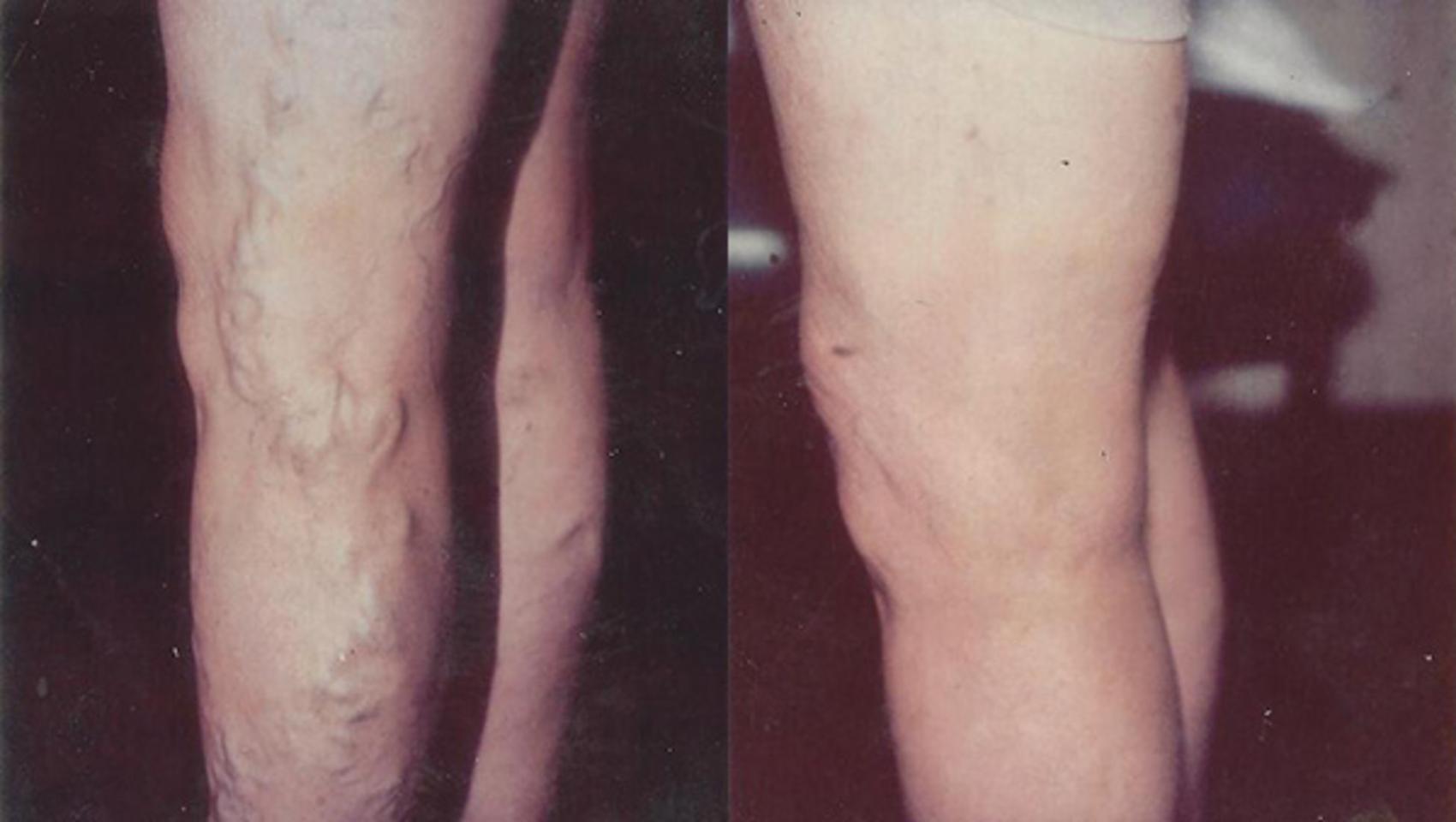Before & After Sclerotherapy Case 62 View #1 View in Atlanta, Georgia