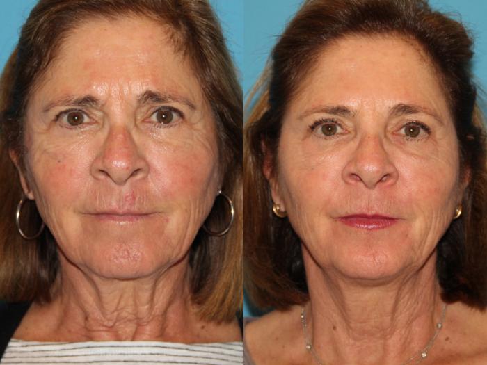 Before & After Facial Rejuvenation Case 111 View #1 View in Atlanta, Georgia