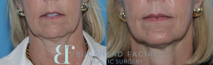Beautiful lower face Sculptra for collagen repletion and neurotoxin for softening downward pull of mouth, chin, and neck by Ashlie Walsh, PA-C