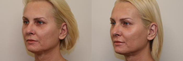 Before & After Laser Treatments Case 53 View #1 View in Atlanta, Georgia