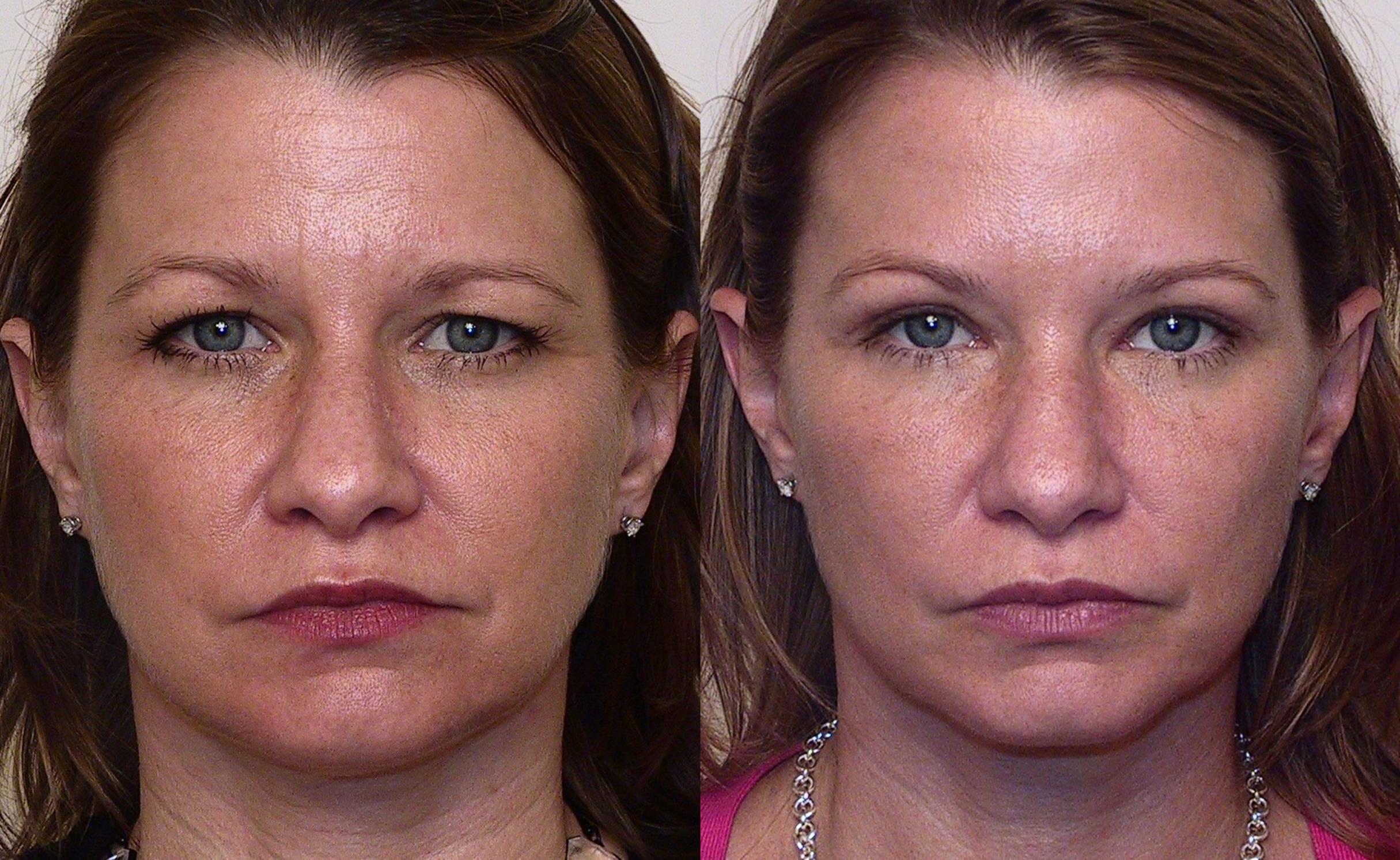 Before & After Blepharoplasty Case 16 View #2 View in Atlanta, Georgia