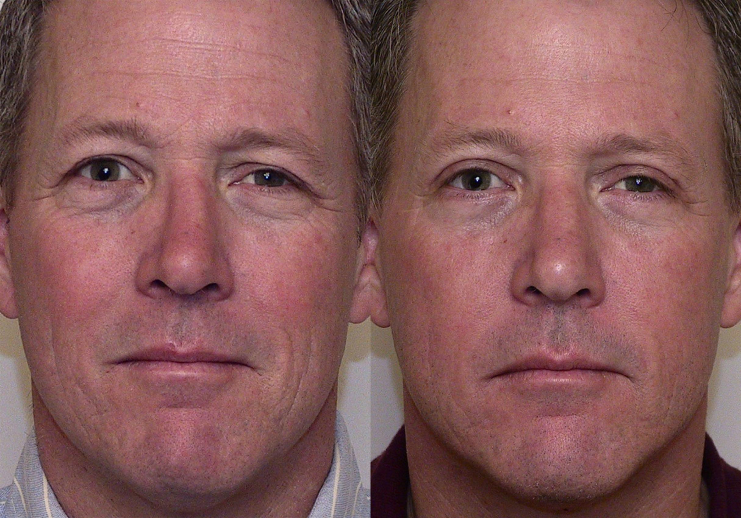 Eyelid Surgery Blepharoplasty Before And After Photo Gallery Atlanta Georgia Buckhead