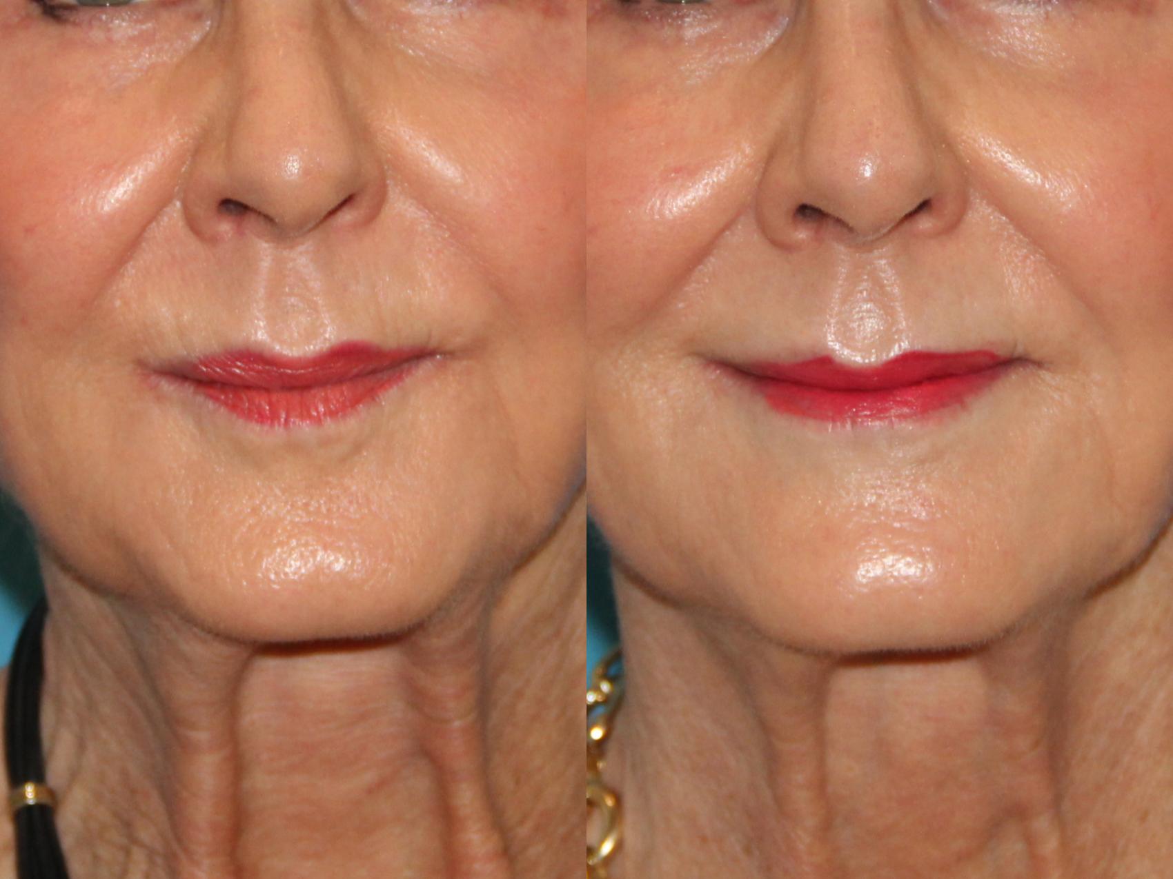 Before & After BOTOX® Cosmetic Case 130 View #1 View in Atlanta, Georgia