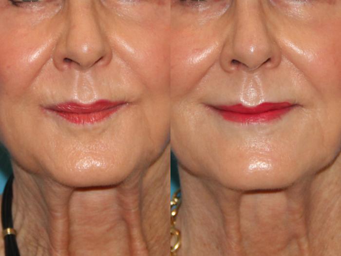 Before & After BOTOX® Cosmetic Case 130 View #1 View in Atlanta, Georgia