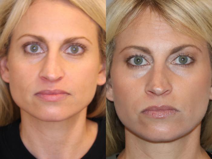Before & After BOTOX® Cosmetic Case 167 Front View in Atlanta, Georgia