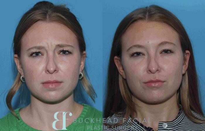 Before and after full-face neurotoxin by Ashlie Walsh, PA-C