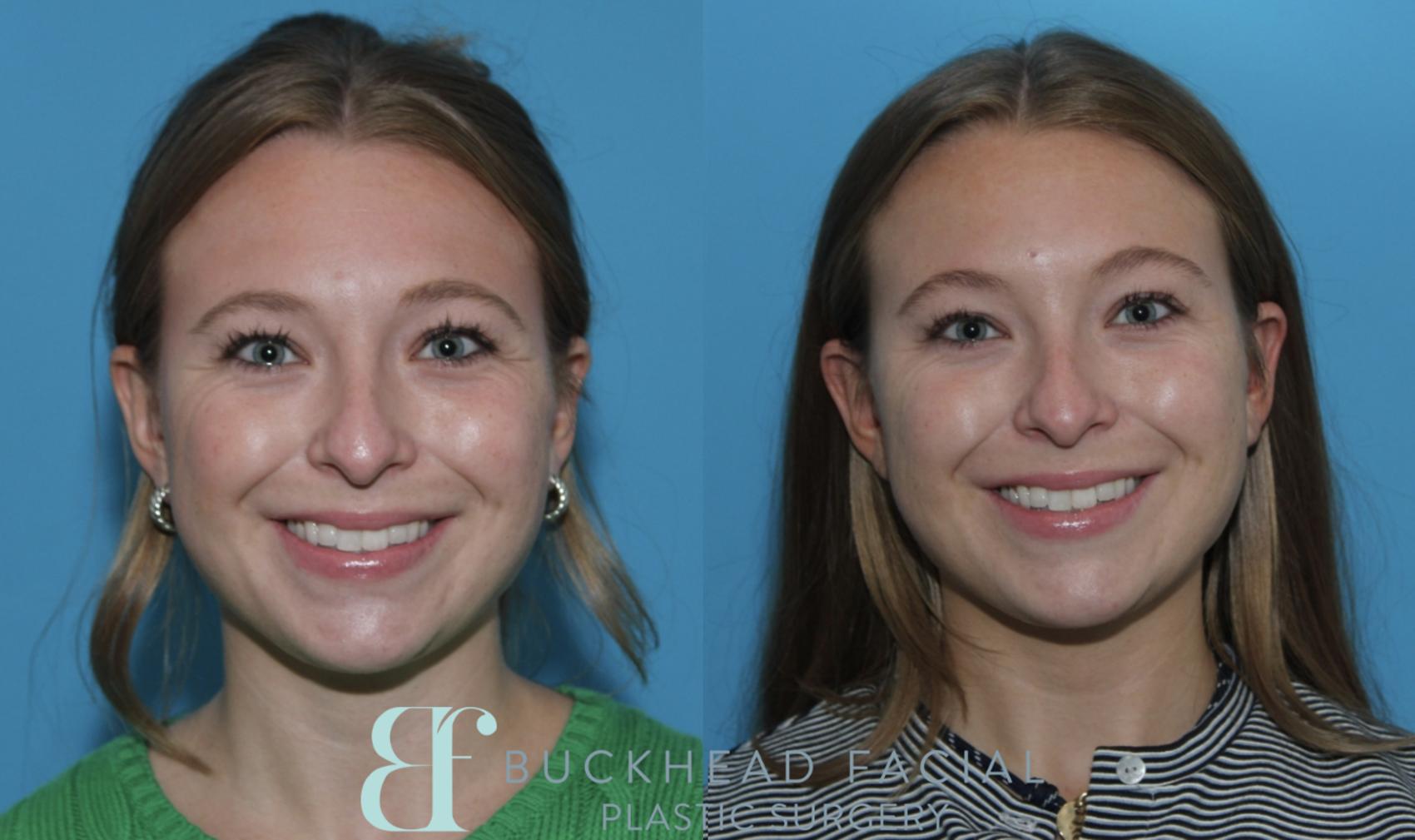 Softened crows feet after full-face neurotoxin by Ashlie Walsh, PA-C