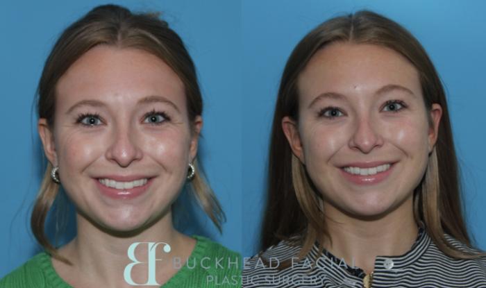 Softened crows feet after full-face neurotoxin by Ashlie Walsh, PA-C