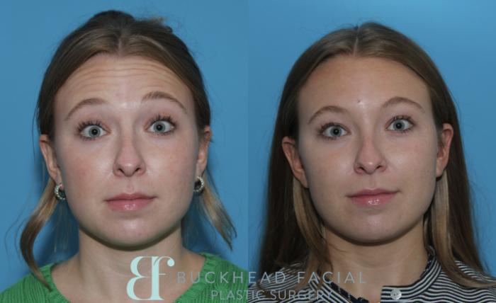 Forehead smoothing with preserved brow lift after neurotoxin by Ashlie Walsh, PA-C