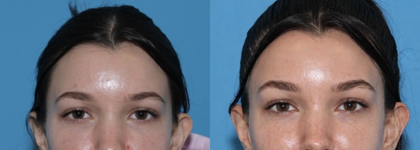 Beautiful, subtle brow lift with Daxxify by Ashlie Walsh, PA-C