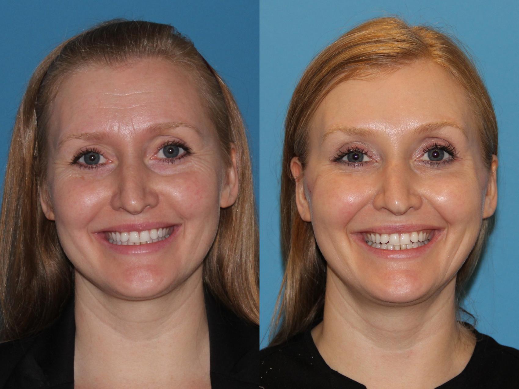 Before & After Dermal Fillers Case 64 View #1 View in Atlanta, Georgia