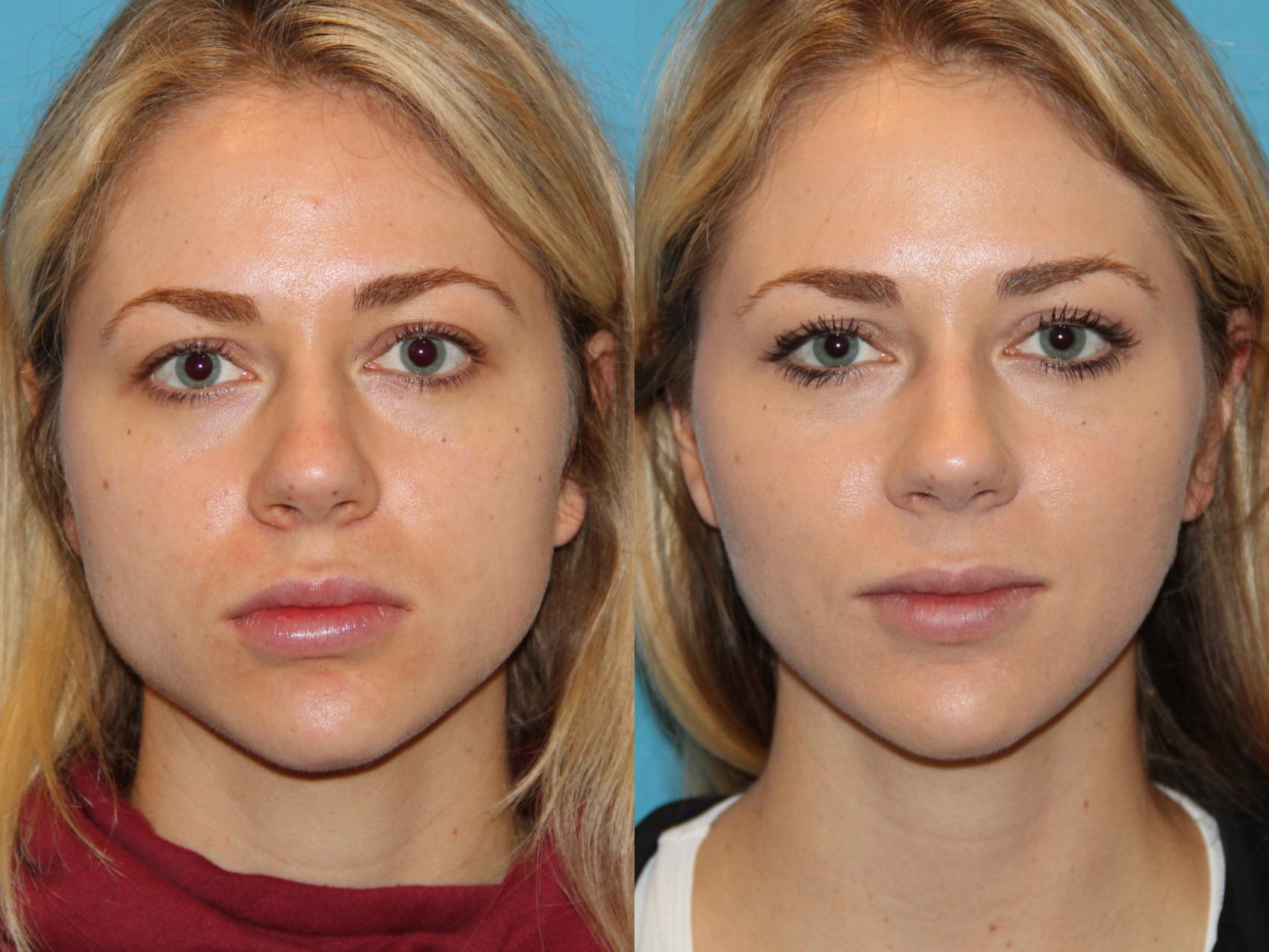 BOTOX® for Masseter & Jaw Before & After Photo Gallery, San Francisco, CA