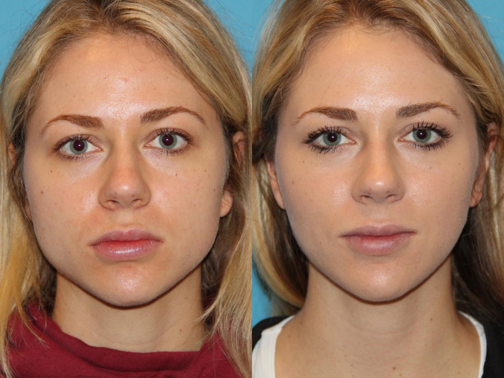 Botox For A Slimmer Jawline