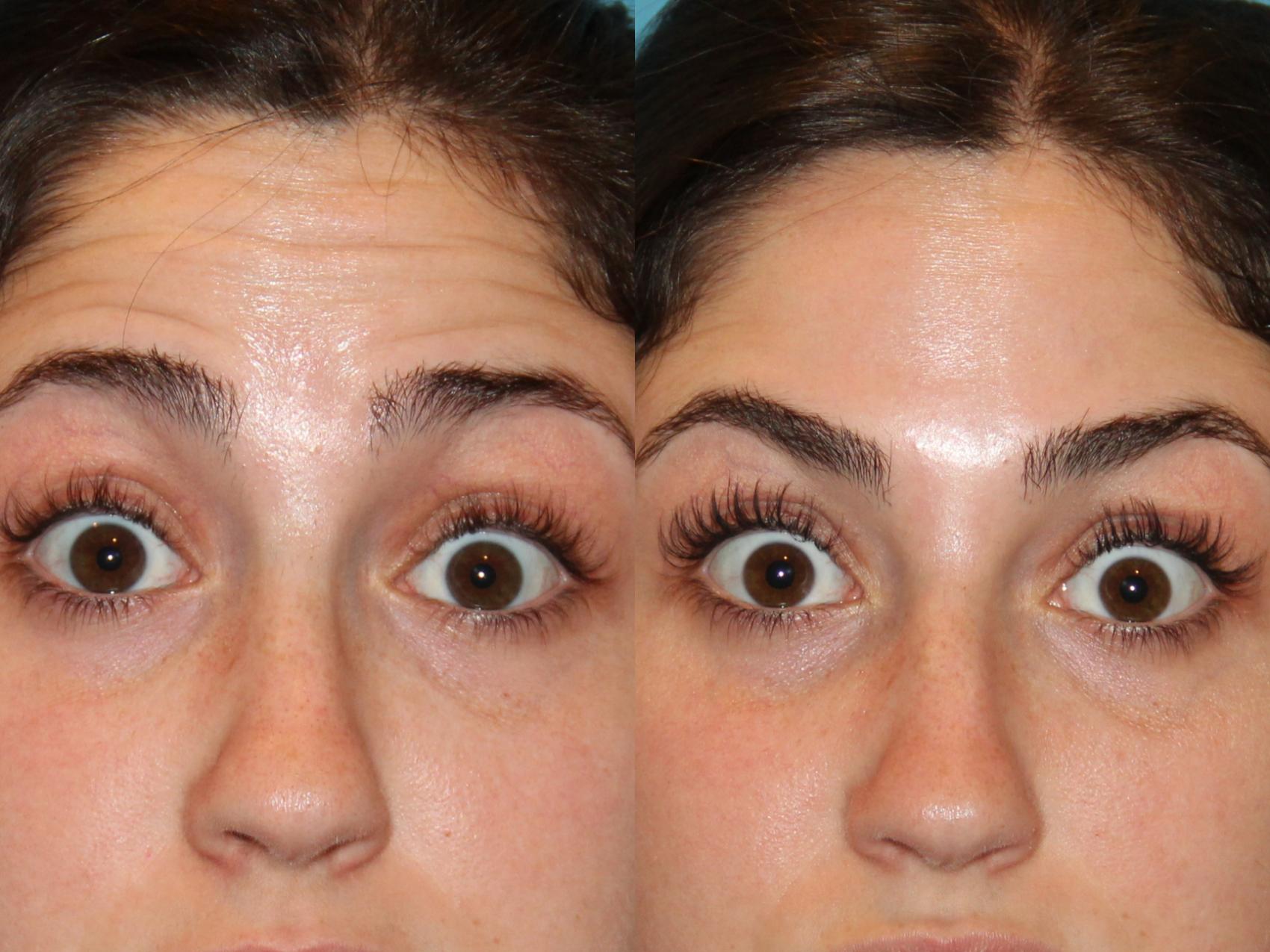 Before & After BOTOX® Cosmetic Case 99 View #1 View in Atlanta, Georgia