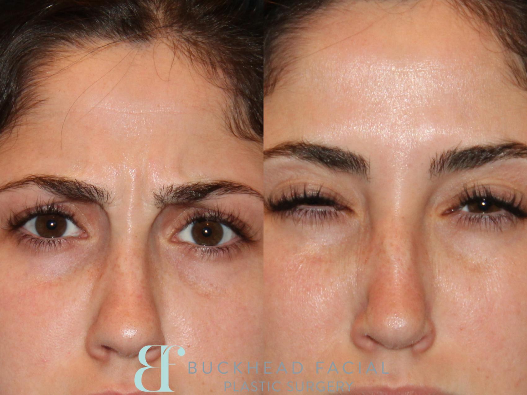 BOTOX® Cosmetic Before and After Pictures Case 99 | Atlanta, Georgia ...