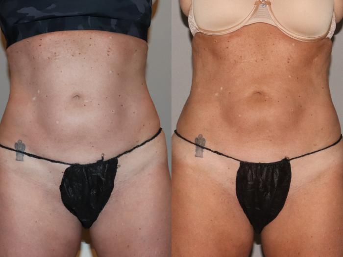 Before & After CoolSculpting® Case 145 Front View in Atlanta, Georgia