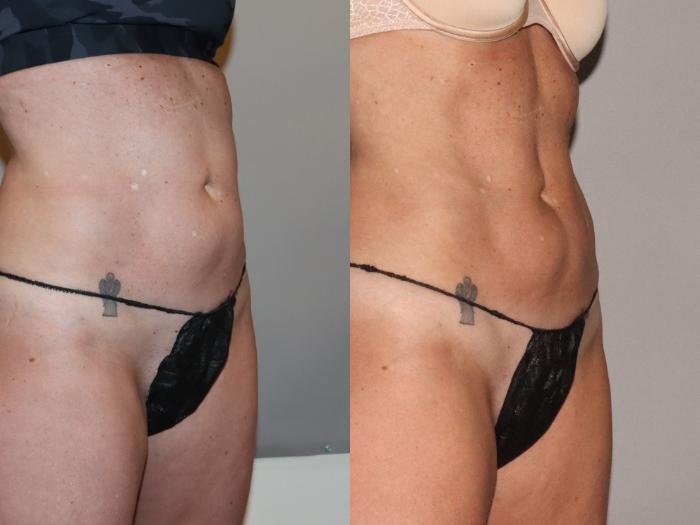 Before & After CoolSculpting® Case 145 Right Oblique View in Atlanta, Georgia