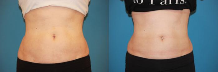 Before & After CoolSculpting® Case 58 View #1 View in Atlanta, Georgia