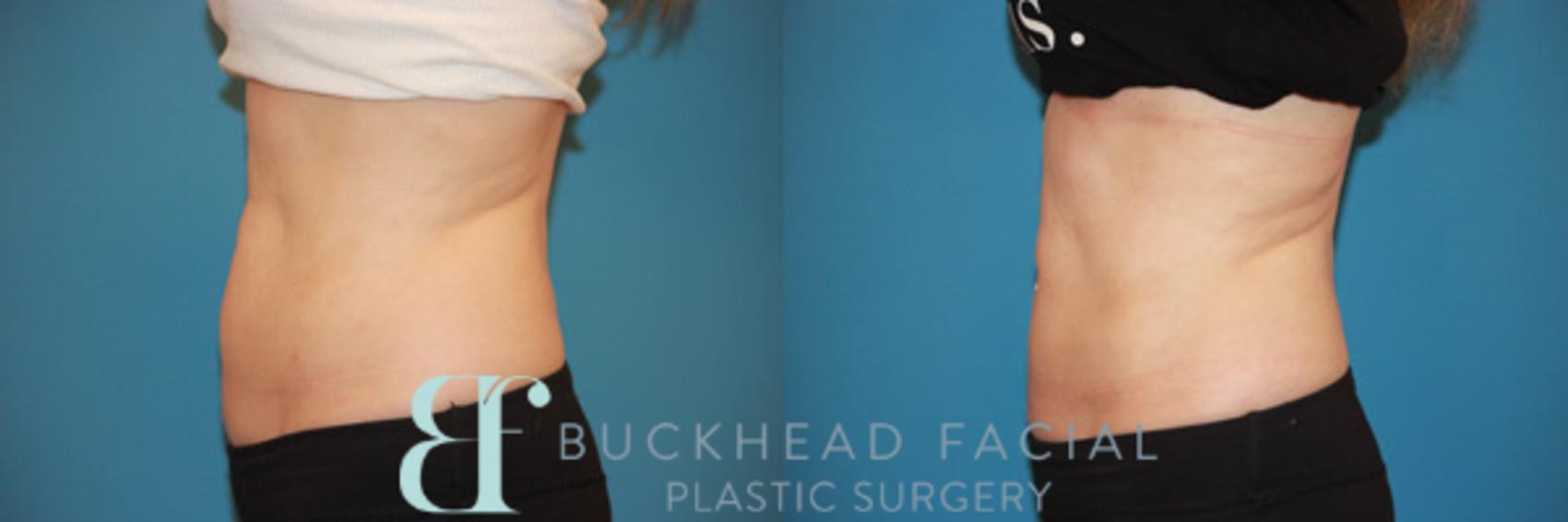 Before & After CoolSculpting® Case 58 View #2 View in Atlanta, Georgia