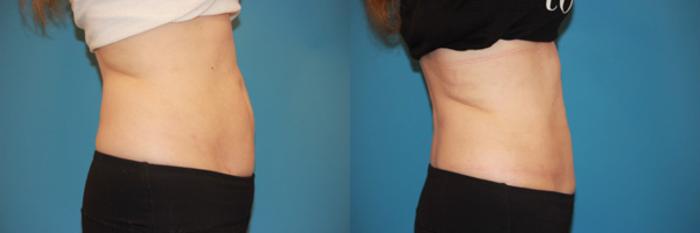 Before & After CoolSculpting® Case 58 View #3 View in Atlanta, Georgia