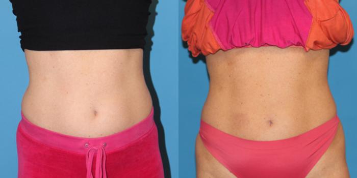 Before & After CoolSculpting® Case 59 View #1 View in Atlanta, Georgia