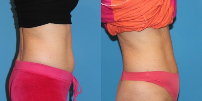 Before & After CoolSculpting® Case 59 View #3 View in Atlanta, Georgia