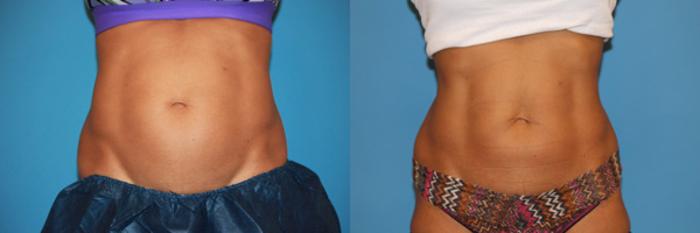 Before & After CoolSculpting® Case 60 View #1 View in Atlanta, Georgia